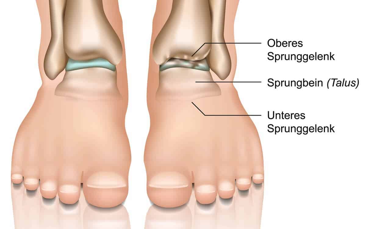 Arthrose in den Füßen